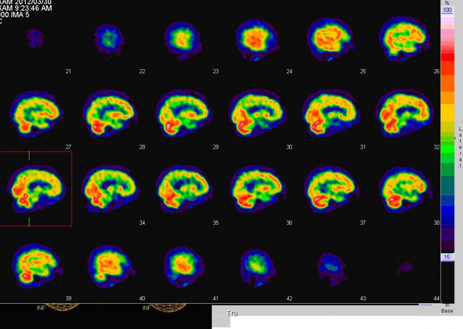 脳血流の分布をみる３軸断面像