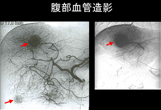 腹部血管造影