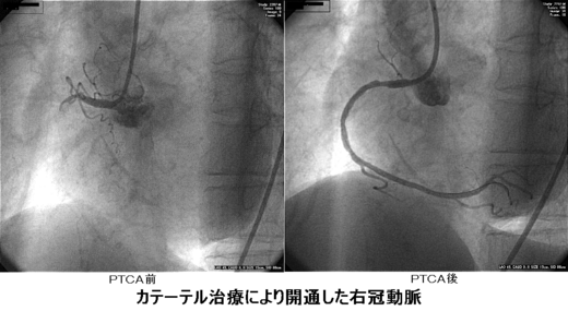 PTCA