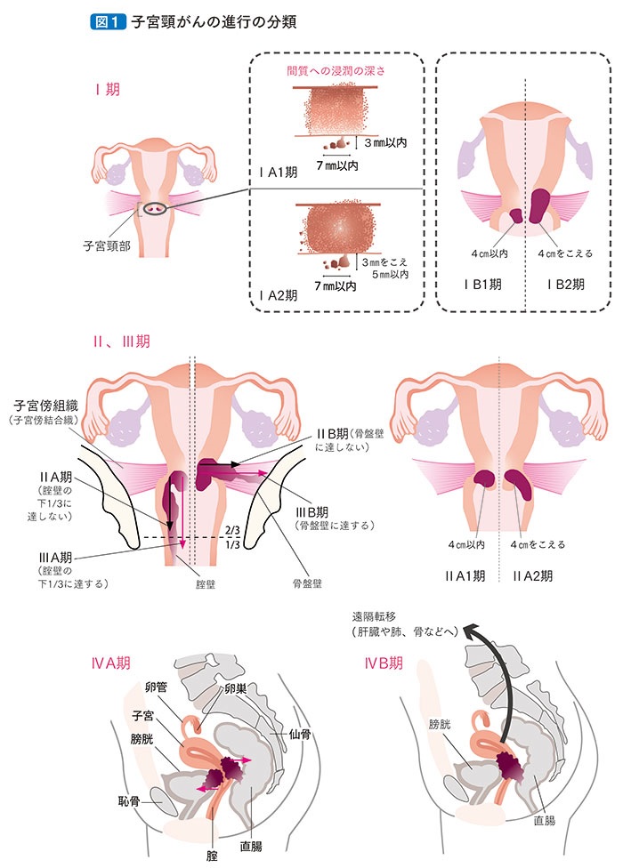 子宮頸がんの進行の分類