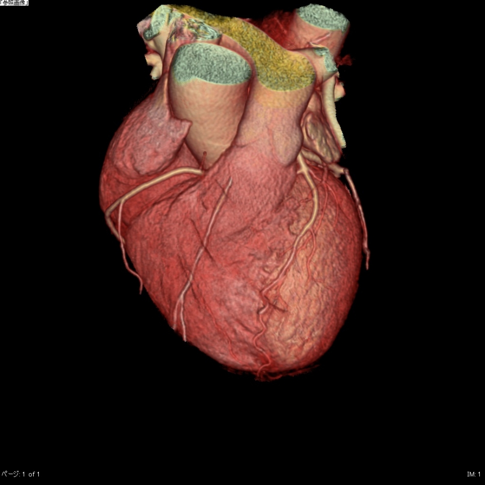 心臓・冠動脈3D像