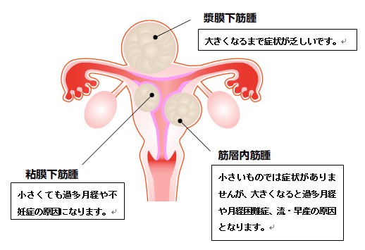 子宮筋腫説明