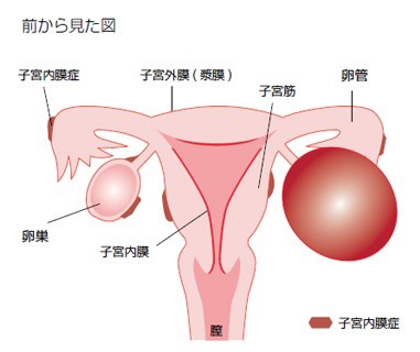 子宮内膜症　前からの図