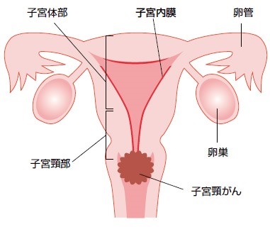子宮頸がん画像