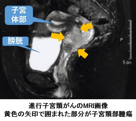 子宮頸がん画像