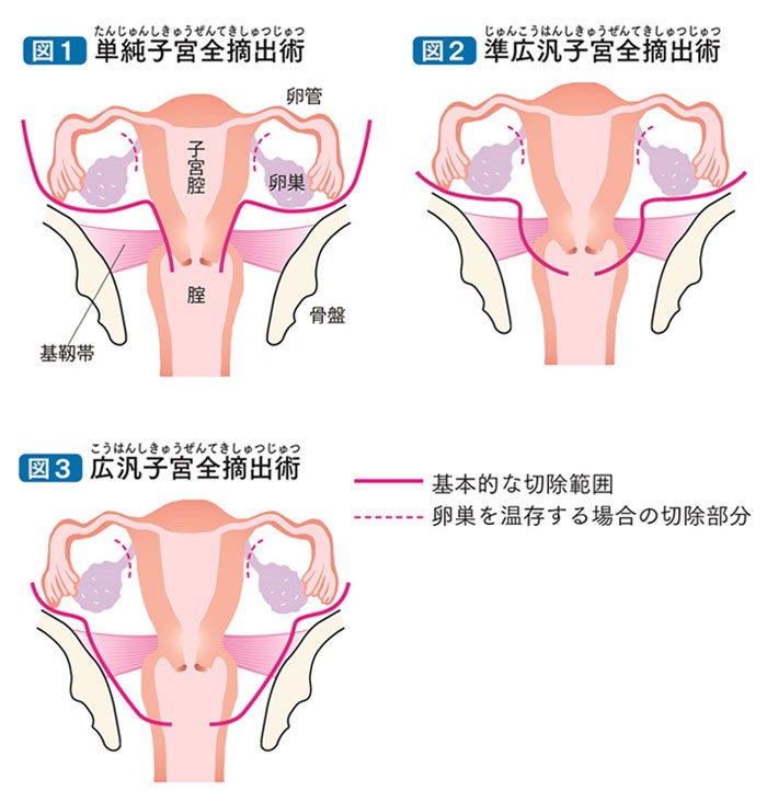 子宮摘出の範囲