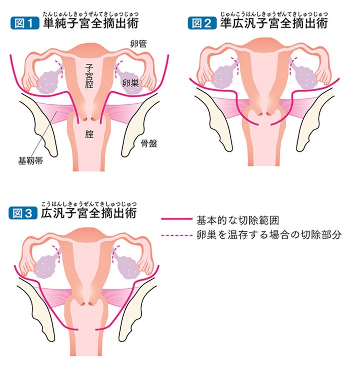 子宮 全 摘出 後 の お腹 の 痛み は いつまで