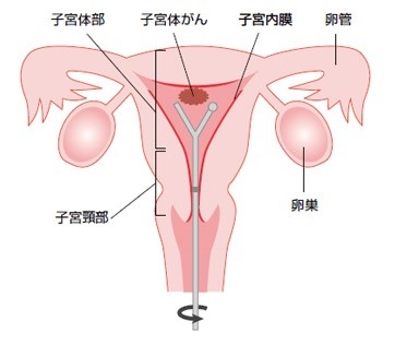 子宮体がん画像