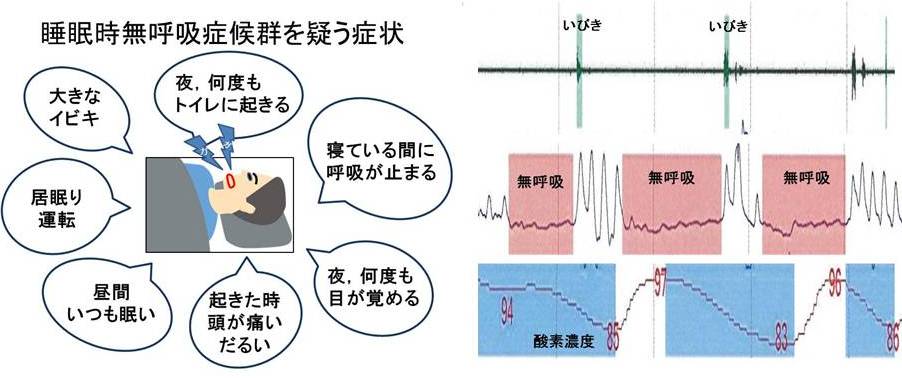 睡眠時無呼吸