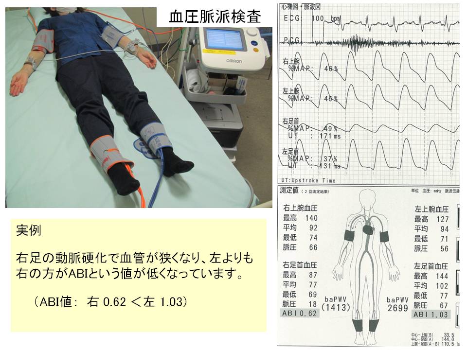 血圧脈波検査