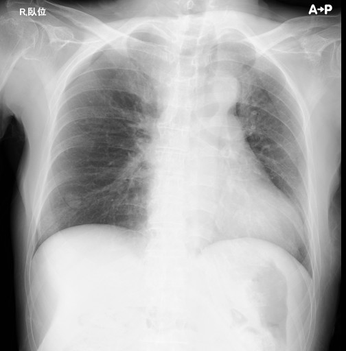 Virtual Gridを使用した胸部臥位X線写真