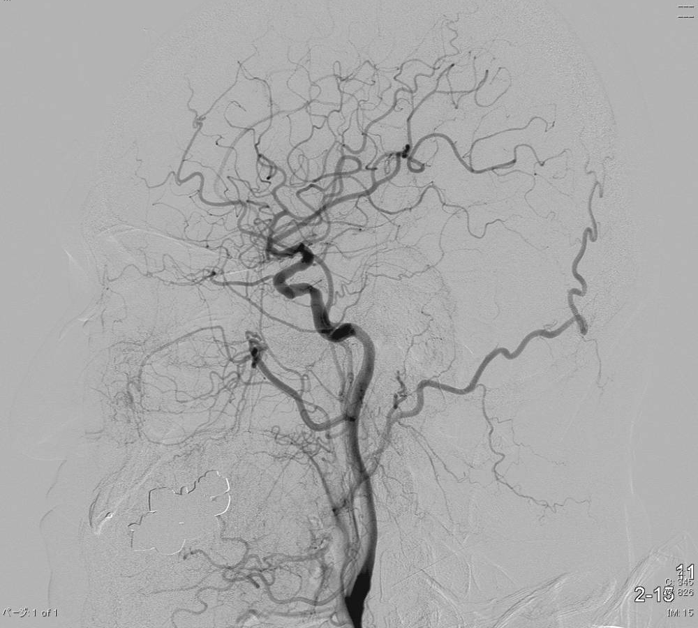頭部血管造影像