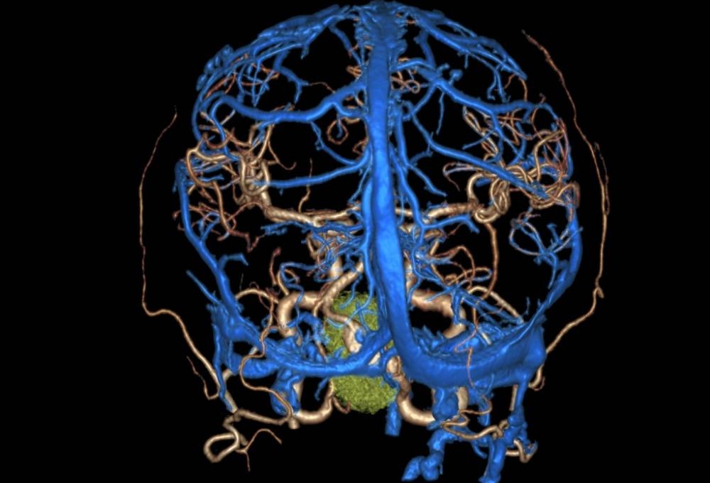 脳血管3D像