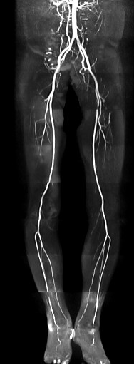 非造影下肢MRA