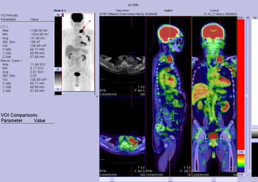 PET CT fusion 画像