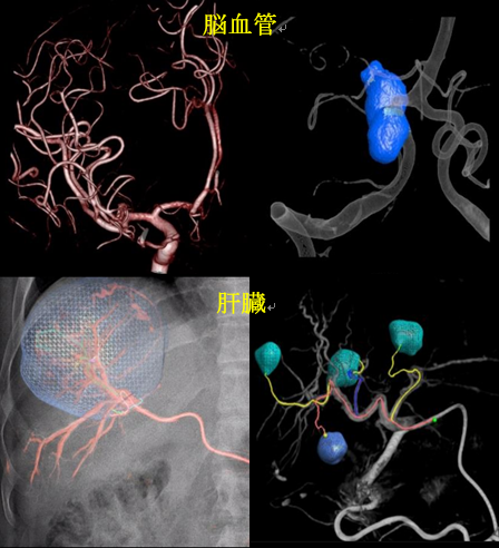 脳血管、肝臓画像