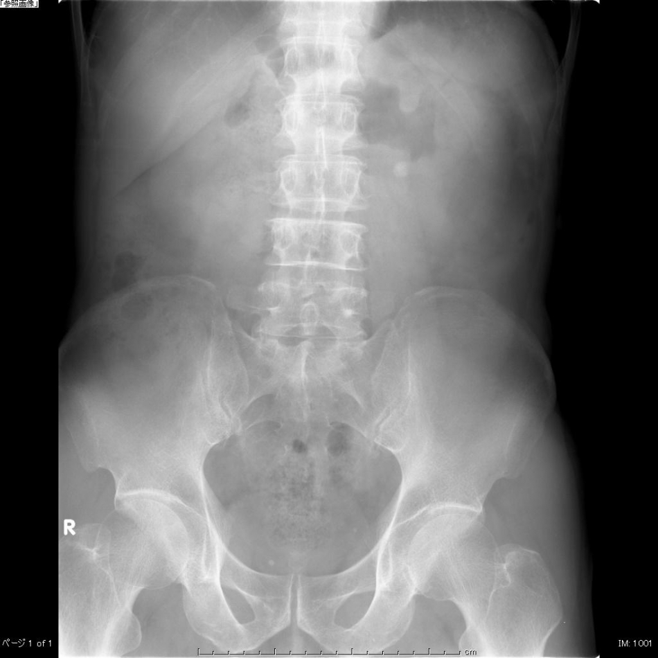 腹部X線写真