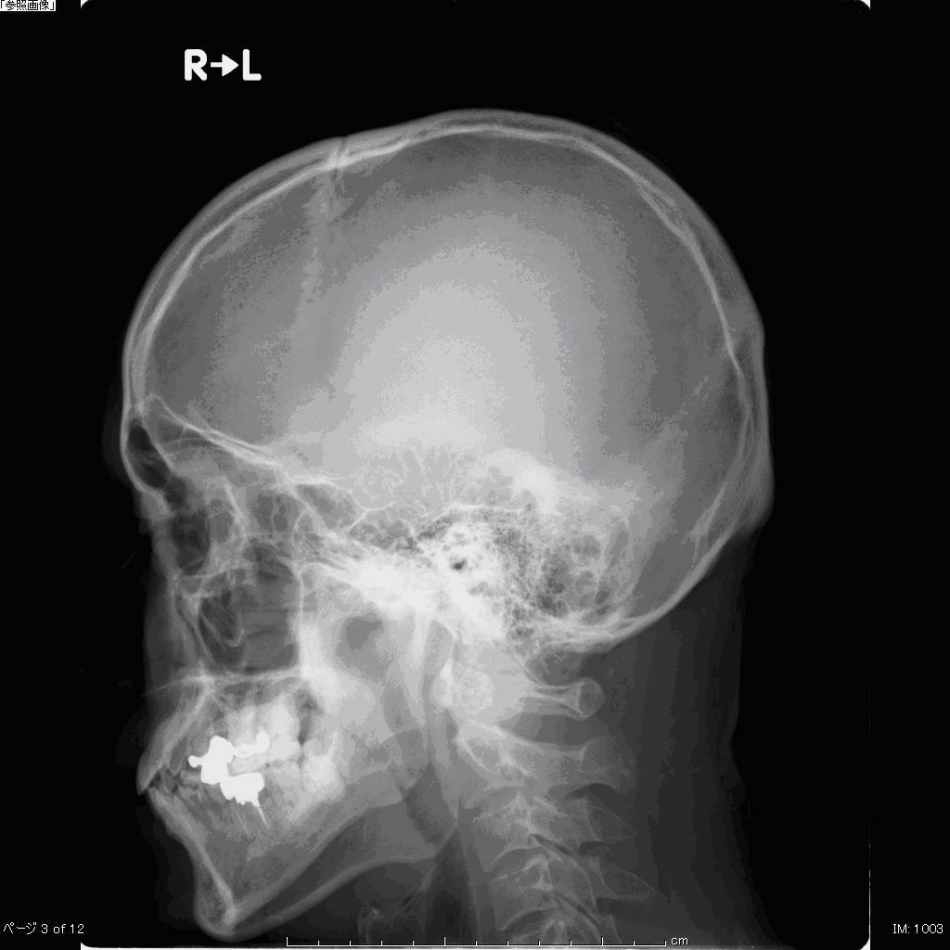 頭部X線写真